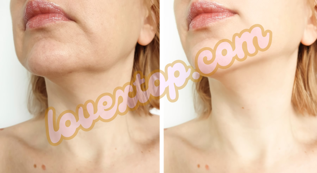 Advanced Skin Tightening Treatment